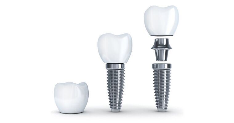 Dental Implants – Restore Your Smile with Advanced and Long-Lasting Solutions